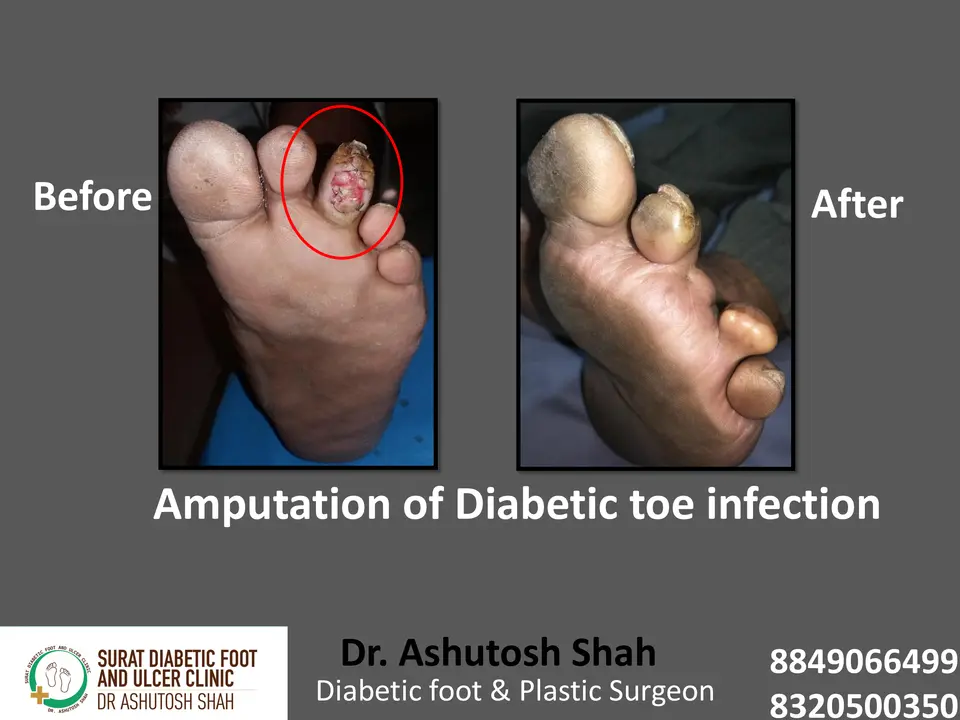 Diabetic Foot  PPT 3 checked by sir.pptx-88.webp